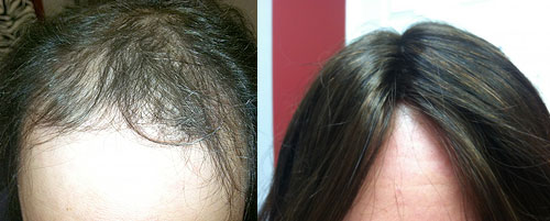 Hair Restoration & Hair Loss Treatment Salon Syracuse NY | Profiles by ...